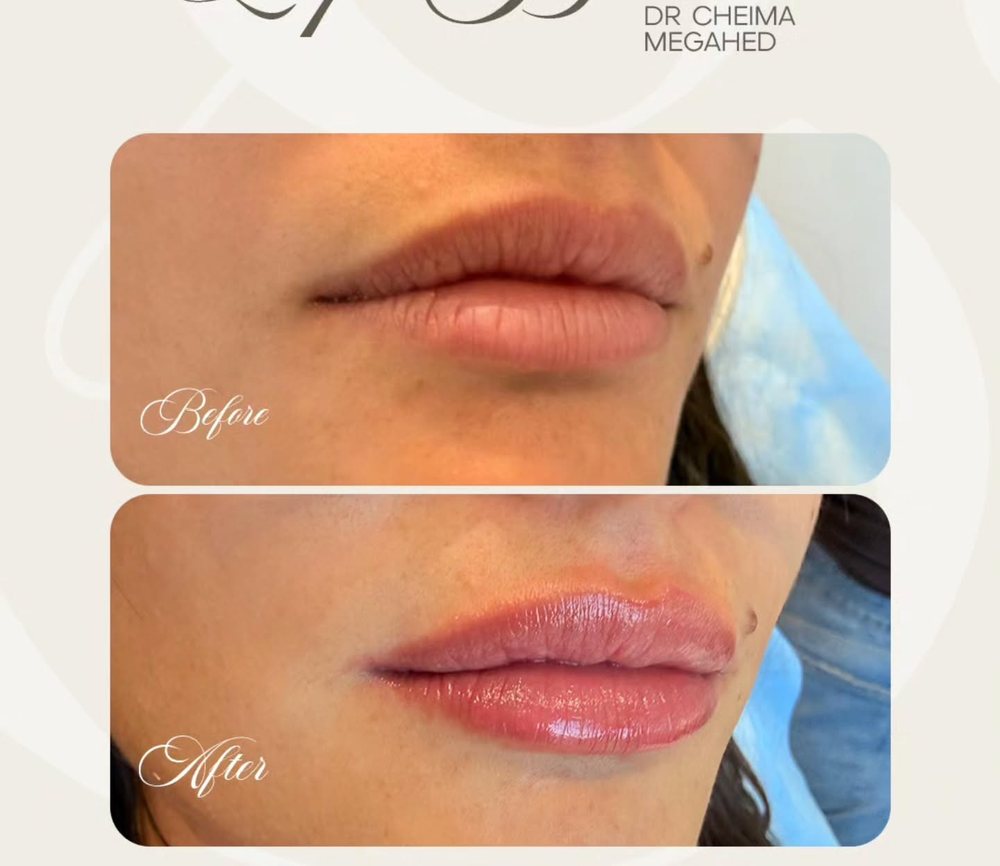 Lip booster before and after