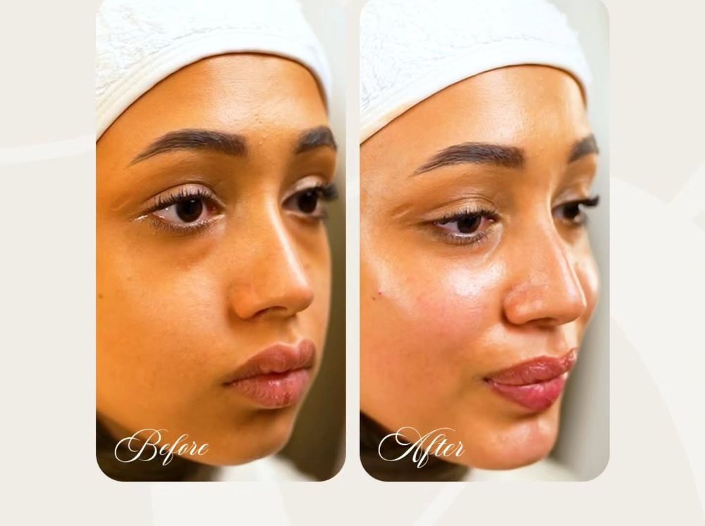 Cheek, jawline and chin filler before and after