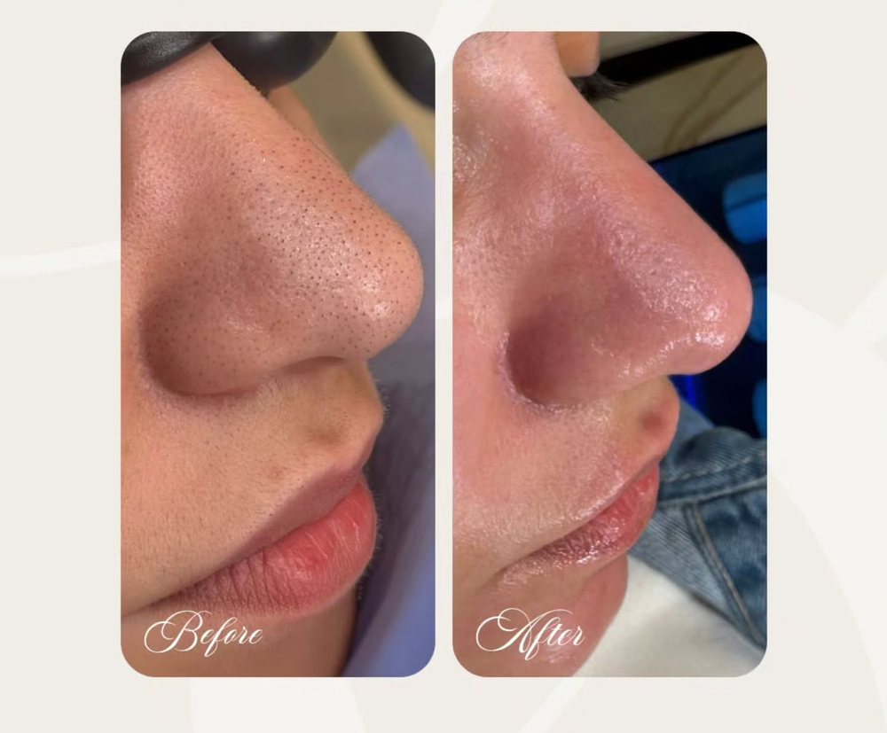 Facial session before and after