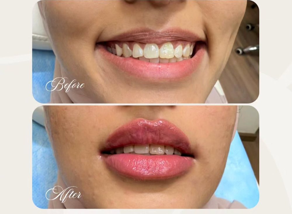 Gummy smile correction before and after