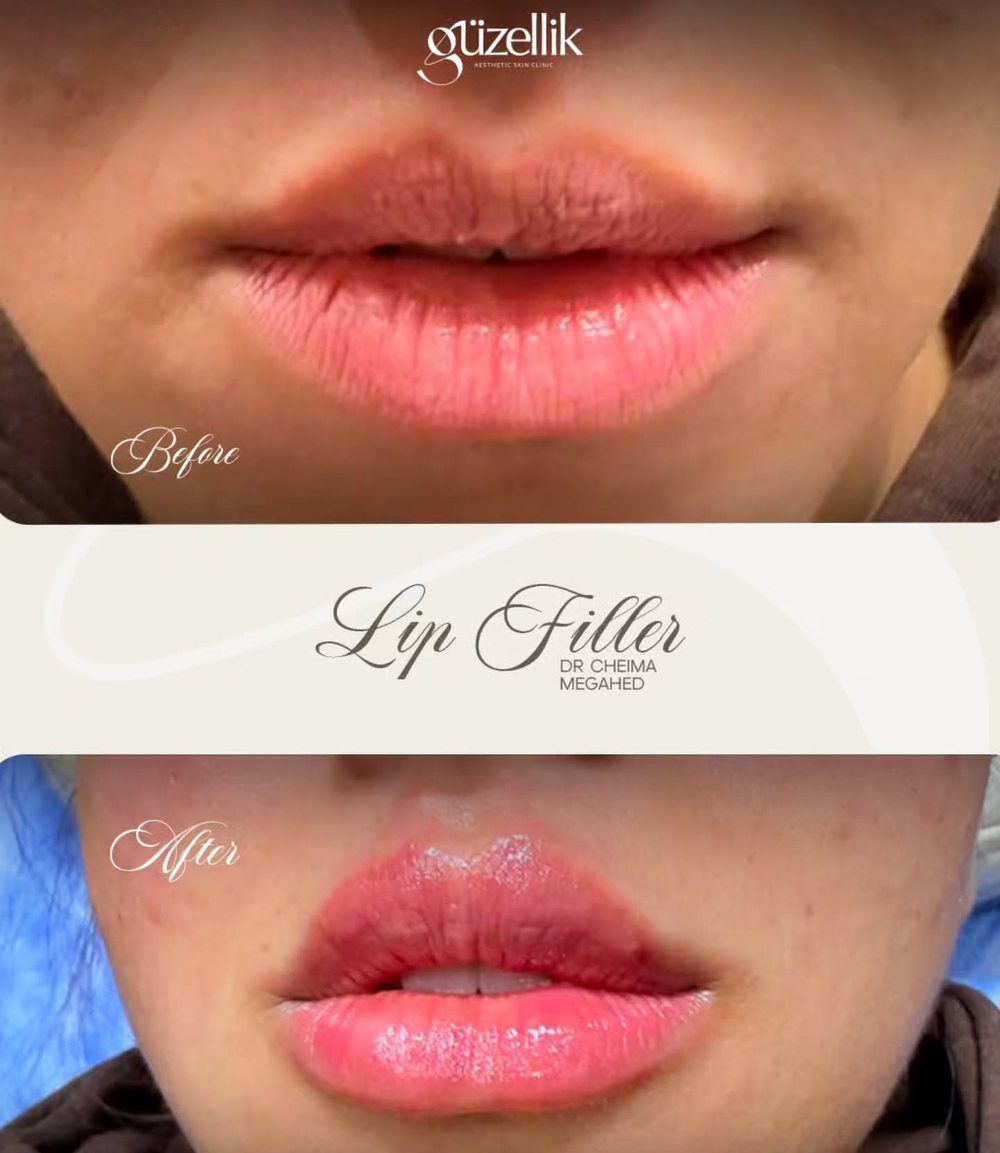 Lip filler before and after