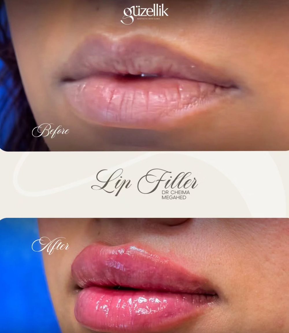 Lip filler before and after