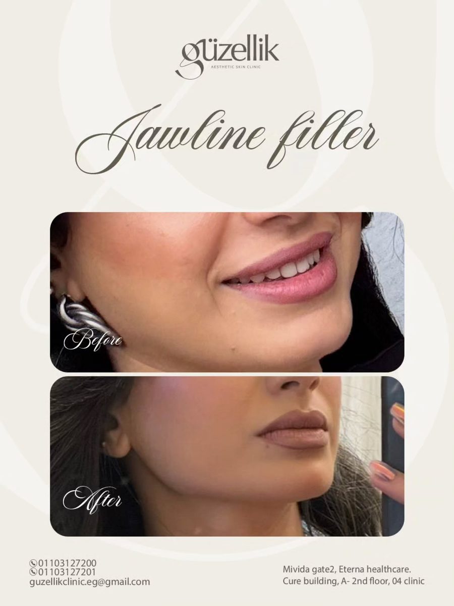 Jawline, Cheek & Chin Filler at güzellik clinic