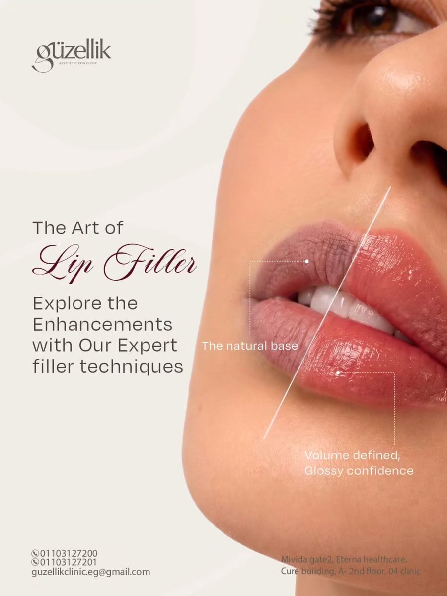 Lip filler artistry by Dr Cheima Megahed